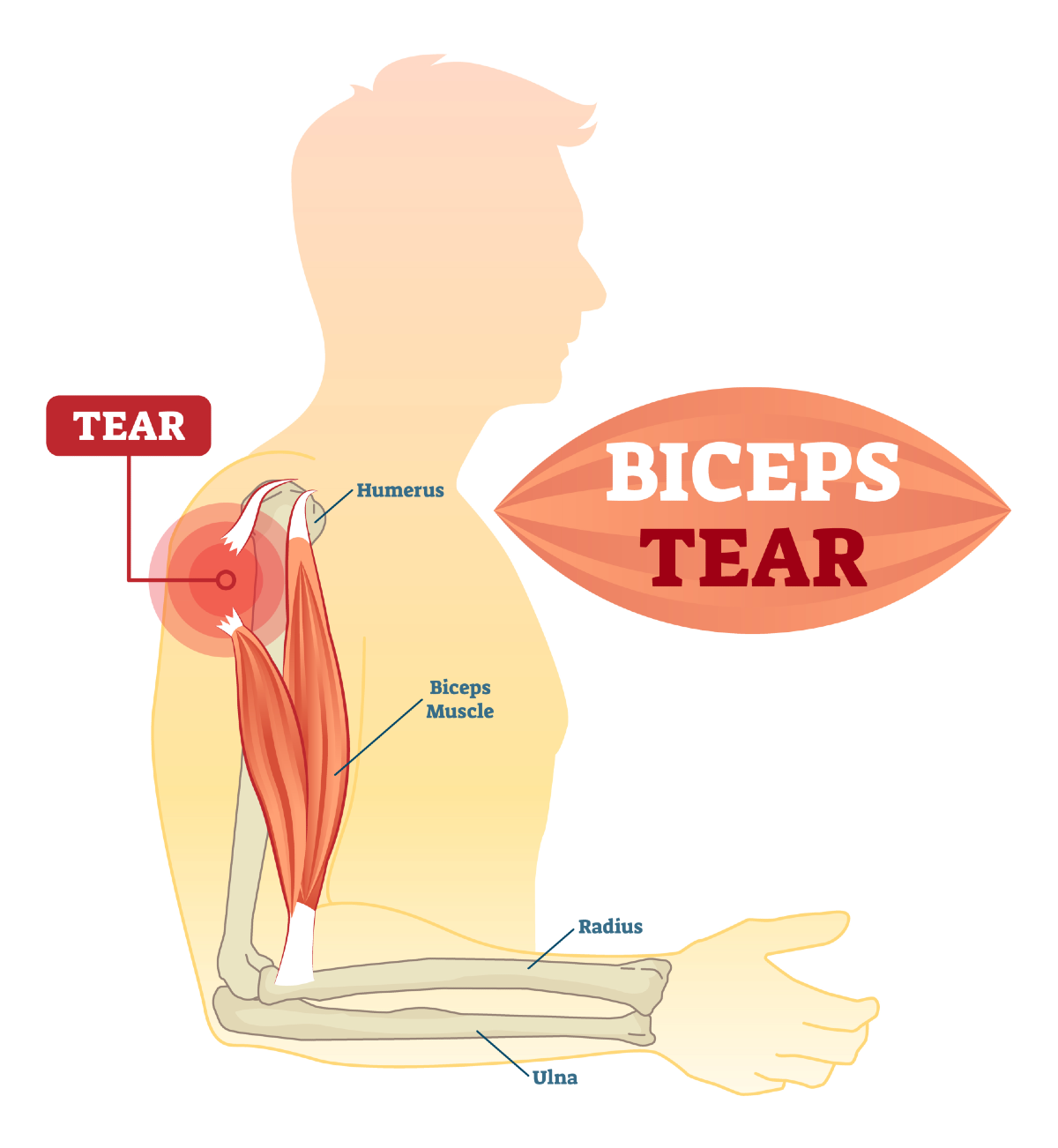 Biceps Tear